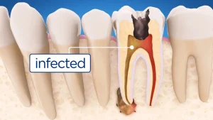 Image showing infected dental pulp inside a molar tooth, used for root canal explanation