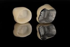 Comparison of PFM and zirconia dental crowns placed by Dr. Aqeel Maqsood at Bright Smile Clinic Faisalabad