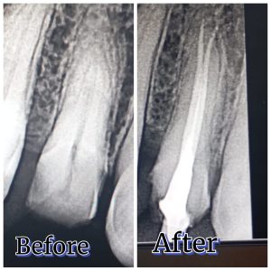 Close-up X-ray of premolar root canal treatment in Faisalabad | [Bright Smile Dental Clinic]
