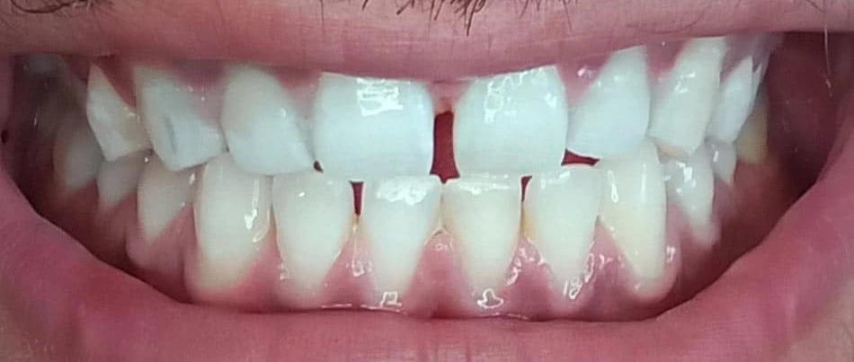 Dramatic teeth whitening results after treatment at Bright Smile Dental Clinic in Faisalabad