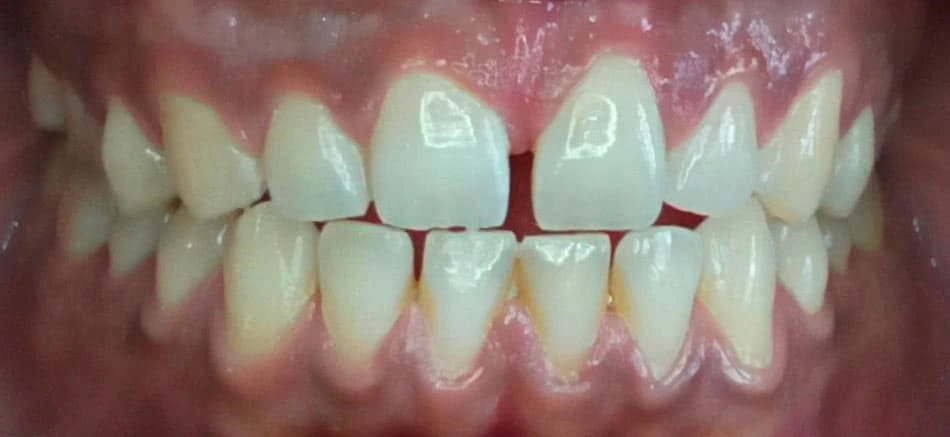 Teeth before professional whitening at Bright Smile Dental Clinic in Faisalabad