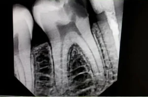 X-ray of a molar tooth with cavity taken at Bright Smile Dental Clinic in Faisalabad